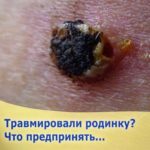 Если Вы травмировали родинку..